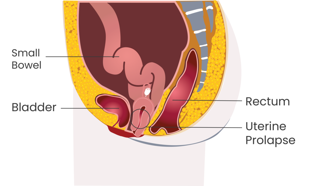 uterine prolapse